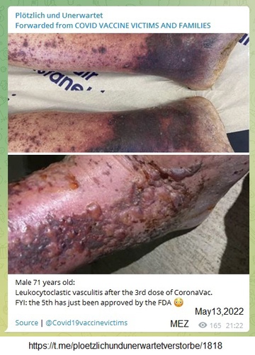 "Corona"-Impfschaden
13.5.2022 mit Leukozytoklastischer Vaskulitis
(Venenentzündung) nach der 3.
"Coronaimpfung" "Corona"-Impfschaden 13.5.2022
mit Leukozytoklastischer Vaskulitis
(Venenentzündung) nach der 3.
"Coronaimpfung"