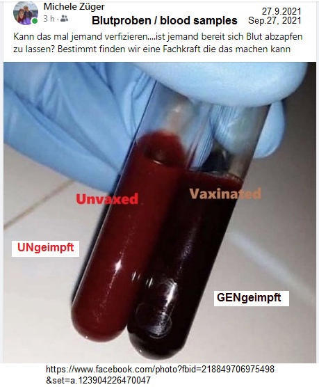 "Corona"-Impfschaden: UNgeimpftes
Blut rot - geimpftes Blut braunrot - 2021 "Corona"-Impfschaden: UNgeimpftes
Blut rot - geimpftes Blut braunrot - 2021