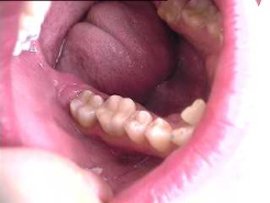 Die Amalgamsanierung
                            mit Keramik-Inlays war erfolgreich. Wenn die
                            ganze Welt nur noch Keramik legen lassen
                            w�rde, so g�be es viele Krankheiten nicht,
                            und viel weniger Quecksilber in Fl�ssen,
                            Seen und Meeren