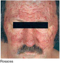 Dermatitis, hier im Gesicht
                            (Rosacea), ist h�ufig durch
                            Amalgam-Quecksilber verursacht. Die �rzte
                            sagen meistens, die Ursache
                            ("�thiologie") sei
                            "unbekannt"