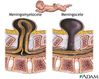 Spina bifida (offener R�cken),
                            Schema des Austritts des R�ckenmarks aus dem
                            R�cken, der durch Quecksilberd�mpfe w�hrend
                            der Schwangerschaft beg�nstigt wird. Die
                            Medizin will diesen Zusammenhang bis heute
                            nicht akzeptieren...