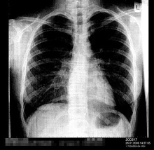 Lungenentzndung (hier ein Rntgenfoto
                            einer einseitigen Lungenentzndung) wird
                            durch Quecksilbervergiftung durch
                            Quecksilberdampf begnstigt