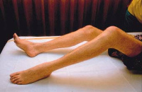 Muskelschwund, z.B. an den Beinen, kann eine
                chronische Vergiftung mit Quecksilberverbindungen als
                Ursache haben. Die Medizin erklrt den Muskelschwund
                einfach fr unheilbar...