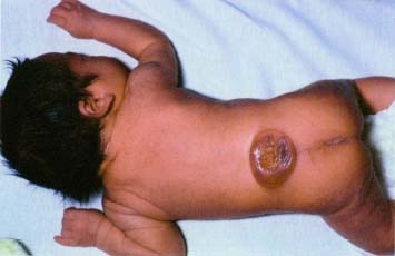 Kind mit offenem Rcken (spina bifida),
                            wo das Rckenmark aus dem Rcken austritt
