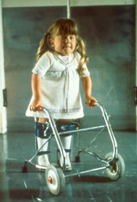 Ein Kind, das einen offenen Rcken
                            (spina bifida) hatte, muss am Laufgestell
                            laufen lernen