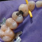 Kofferdamm f�r Amalgamsanierung:
                              Amalgamsanierungen m�ssen unbedingt
                              schrittweise und jeweils mit einem
                              Kofferdamm ausgef�hrt werden, um das
                              Einatmen von Quecksilber und
                              Quecksilberd�mpfen zu vermeiden, sonst ist
                              ein Nierenversagen nicht unwahrscheinlich