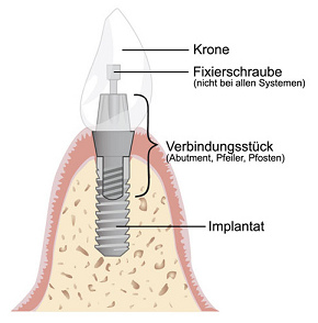 Schema
                                eines Zahnimplantats: Da kommt jede
                                Menge Titan und vielleicht noch weitere
                                Metalle in den Mund. Die
                                "Wissenschaft" kreierte den
                                neuen Zweig der
                                "Implantologie" ohne Wissen um
                                die Metallwirkungen im K�rper