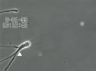 Nerven unter
                                        Quecksilbereinfluss (R�ntgenfoto
                                        04): Die Nerven bilden sich
                                        weiter zur�ck, es bleiben nur
                                        noch Nervenfasern