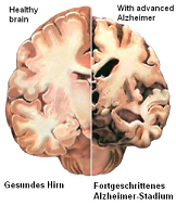 El
                      cerebro Alzheimer perdi una grande parte de su
                      substancia cuando en comparacin a un cerebro
                      sano. El mercurio esencialmente es una parte de
                      ese proceso.