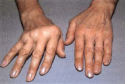 Chronische Polyarthritis
                          (Gelenkentzndung, Rheuma) mit Handskoliose