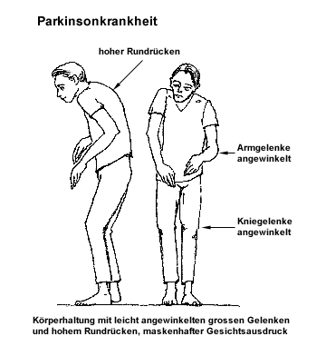 Personas afectadas
                        por la enfermedad de Parkinson tienen ms
                        amalgamas en sus bocas que personas sin
                        Parkinson. Parkinson tambin es causado por
                        pesticidas y por impregnantes para la madera.