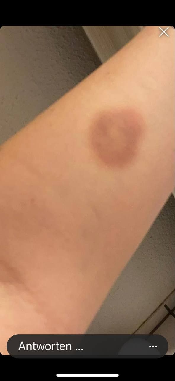 Fleck nach der 2. Genspritze Moderna 03 Fleck nach der 2. Genspritze Moderna 03