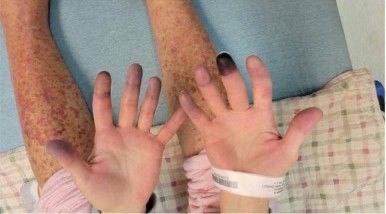 SCHLANGENGIFTimpfschaden
                    "USA" 18.10.2022: Diabetes mit Nekrose an
                    den Fingern - schwarze Finger