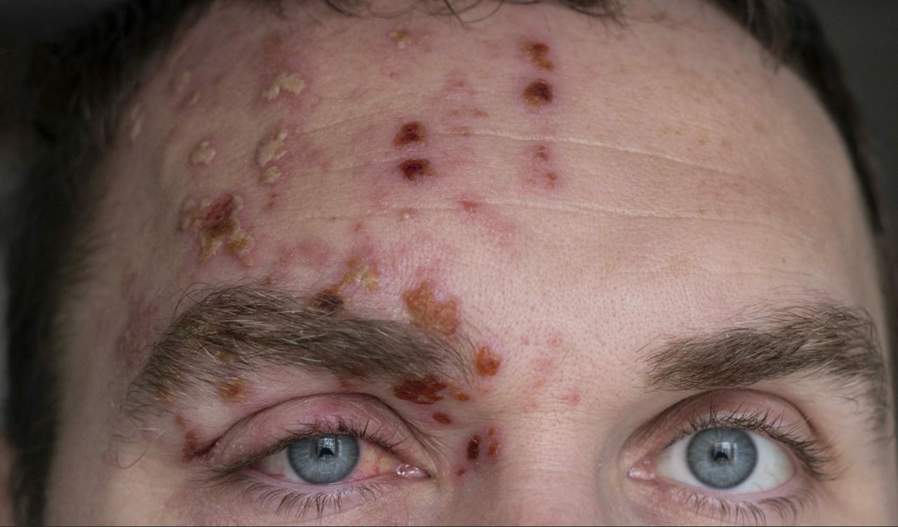 Verdacht "Corona"-Impfschaden
Schweiz irgendwo 26.1.2024: Gürtelrose an der Stirn Verdacht "Corona"-Impfschaden Schweiz
irgendwo 26.1.2024: Gürtelrose an der Stirn