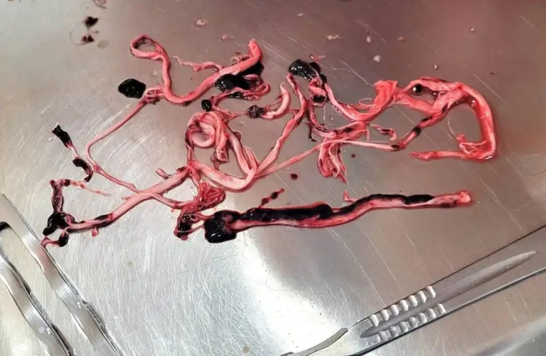 Faserblutgerinnsel Faserblutgerinnsel