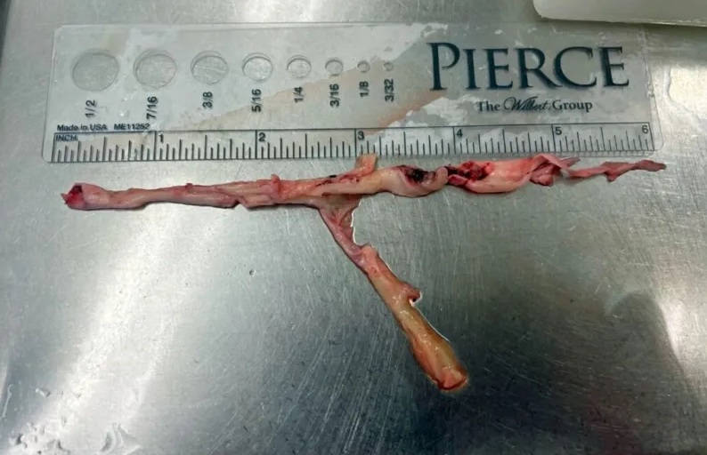 Faserblutgerinnsel Zoom Faserblutgerinnsel Zoom