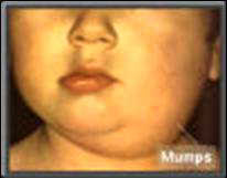 Mumps
                        ist bei Blutgruppe B besonders hufig