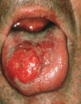 Cancer (ici un
                        cancer de la langue) est diffrent selon les
                        groupes sanguins et donc l'on peut le gurir de
                        manire diffrente.