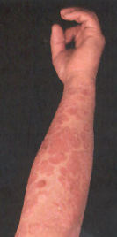 Le psoriasis est
                        provoqu� par l'alimentation contre le groupe
                        sanguin, en particulier chez le groupe sanguin
                        0.