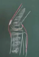 Das Kniegelenk mit
                        Oberschenkelstrecker (rot nach oben) und
                        Wadenmuskel (rot nach unten)