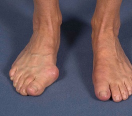 Hallux Valgus Hallux Valgus
