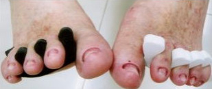 Abgeschliffene Fussnägel Abgeschliffene Fussnägel