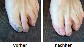 Alte Fussnägel und
geschliffene Fussnägel, Vorher-Nachher-Fotos Alte Fussnägel und geschliffene Fussnägel,
Vorher-Nachher-Fotos