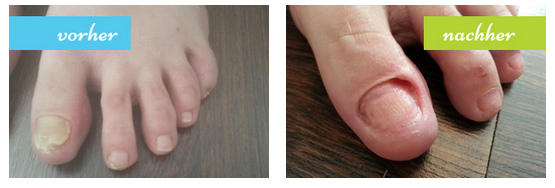 Fussnagelstudio zum Fussnägel abschleifen
von Michel Sigg, Vorher-Nachher-Fotos Fussnagelstudio zum Fussnägel abschleifen von
Michel Sigg, Vorher-Nachher-Fotos