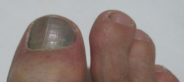 Hämatom unter dem Fussnagel des
rechten grossen Zehs, 1.Juli 2019 Hämatom unter dem Fussnagel des
rechten grossen Zehs, 1.Juli 2019