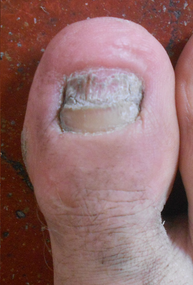 Der Fussnagel wächst nur halb
nach, 20.11.2021 Der Fussnagel
wächst nur halb nach, 20.11.2021