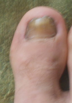 Der Fussnagel wächst dann schnell
nach, staut aber an der Spitze, 13.6.2020 Der Fussnagel wächst dann schnell nach,
staut aber an der Spitze, 13.6.2020