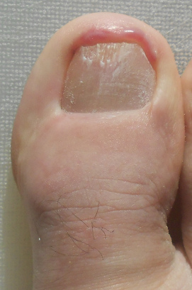 Fussnagel abgeschliffen, 9.3.2021 Fussnagel abgeschliffen, 9.3.2021