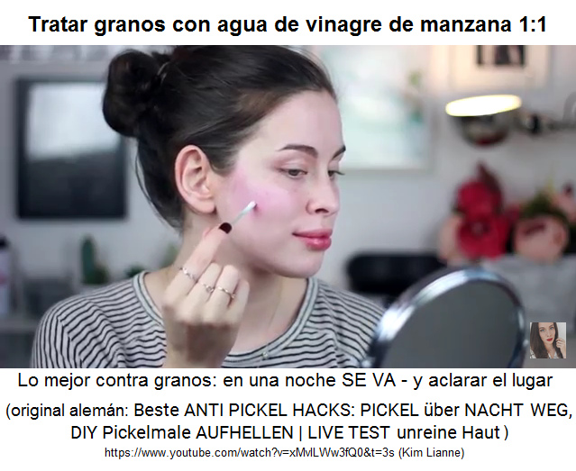 Tratar granos (espinillas) con
                agua de vinagre de manzana que es mezclado con la
                proporci�n de 1:1