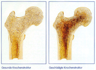 Knochen gesund und mit Knochenschwund
                              (Osteoporose) (02)