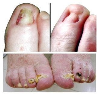 Faulende Zehennägel
entstehen durch jahrelangen Missbrauch von
Blutverdünnern und Blutdrucksenkern, eventuell
beschleunigt durch Alkoholmissbrauch und
Nikotinmissbrauch Faulende Zehennägel
entstehen durch jahrelangen Missbrauch von
Blutverdünnern und Blutdrucksenkern, eventuell
beschleunigt durch Alkoholmissbrauch und
Nikotinmissbrauch