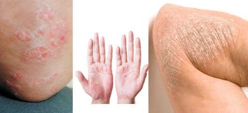 Türkei Kangal: Fälle mit Psoriasis Türkei Kangal: Fälle mit Psoriasis