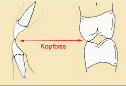 Beim sogenannten
"Kopfbiss" beissen Kanten der
Schneidezähne und die Höcker der
Backenzähne und Mahlzähne aufeinander
und schleifen sich gegenseitig ab Beim sogenannten
"Kopfbiss" beissen Kanten der
Schneidezähne und die Höcker der
Backenzähne und Mahlzähne aufeinander
und schleifen sich gegenseitig ab