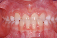 Con la mordida
                        cruzada frontal los dientes incisivos inferiores
                        estn antes de los dientes incisivos superiores