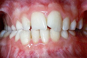 Beim
sogenannten "Kreuzbiss" stehen
beim "seitlichen Kreuzbiss"die
unteren Backenzähne und Mahlzähne mehr
nach aussen als die oberen: Die zur Wange
gerichteten Höcker ("bukkale
Höcker") der unteren Backenzähne und
Mahlzähne stehen frei. Beim sogenannten
"Kreuzbiss" stehen beim
"seitlichen Kreuzbiss"die
unteren Backenzähne und Mahlzähne mehr
nach aussen als die oberen: Die zur Wange
gerichteten Höcker ("bukkale
Höcker") der unteren Backenzähne und
Mahlzähne stehen frei.