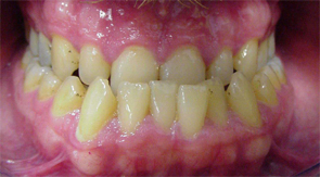 Posicin mesial: La
                        mandbula es mucho ms grande que el maxilar
                        superior