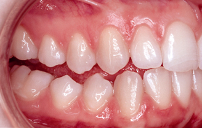 Beim seitlichen,
offenen Biss kommen die oberen Backen- und
Mahlzähne nicht an die unteren heran Beim seitlichen, offenen Biss kommen
die oberen Backen- und Mahlzähne nicht an
die unteren heran