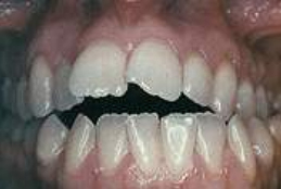 Durch zu viel Daumenlutschen
                              oder Sauger (Flaschensauger oder Nuggi)
                              ergibt sich die Zahnfehlstellung des
                              "offenen Biss" bei den
                              bleibenden Zhnen. [21]