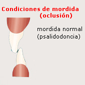Mordida normal (psalidodoncia), esquema Mordida normal (psalidodoncia),
esquema