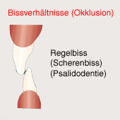 Schneidezähne im
"Scherenbiss", Schema Schneidezähne im "Scherenbiss",
Schema