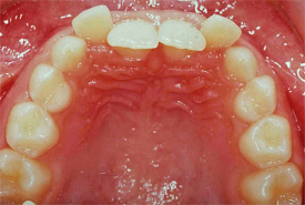 Zahnfehlstellung mit gekippten, vorderen
Schneidezähnen Zahnfehlstellung mit
gekippten, vorderen Schneidezähnen