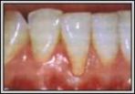 Zur�ckgegangenes
                        Zahnfleisch