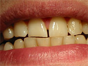 Durch Z�hneknirschen (Bruxismus)
                            abgeschliffene obere Schneidez�hne