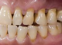 Zahnfleischschwund, z.B. durch Parodontitis. Aber
                da sind noch viel mehr mgliche Ursachen