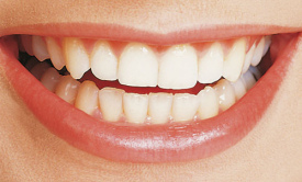 Im Gegensatz dazu haben normale Z�hne
                              leicht unterschiedliche Formen und leicht
                              unterschiedliche H�hen