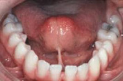 Bndchen (hier ein zu kurzes
                            Zungenbndchen), die zu nah an den Zhnen
                            ansetzen, knnen an Zahninnenseiten einen
                            Zahnfleischrckgang provozieren